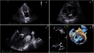 Graphical Abstract Doble orificio mitral aislado como cardiopatía co...