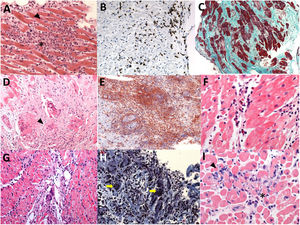 Muestras de biopsias endomiocárdicas de pacientes con sospecha de miocarditis. A: (H-E×200) miocarditis linfocítica con criterios de Dallas positivos; infiltrado linfocitario (asterisco) y necrosis con rotura de fibras miocárdicas (punta de flecha). B: miocarditis linfocítica con criterios inmunohistoquímicos positivos; las inclusiones de color marrón corresponden a linfocitos CD3+ (punta de flecha). C: (tricrómico de Masson,×100) miocardiopatía dilatada; presencia de extensa fibrosis (representada por tinción azul-verdosa). D: (H-E, ×200) sarcoidosis cardiaca con presencia de granulomas (punta de flecha). E: otro ejemplo de sarcoidosis cardiaca con granulomas (punta de flecha) F: (H-E, ×400) miocarditis eosinolífica (eosinófilos señalados con punta de flecha). G: (H-E, ×200) miocarditis de células gigantes (punta de flecha). H: otro ejemplo de miocarditis de células gigantes (flechas amarillas, células gigantes multinucleadas). I: (H-E, ×400) miocarditis por pembrolizumab (inhibidor del punto de control inmunitario); se observa infiltrado linfocitario (punta de flecha) y eosinófilos aislados (asterisco). H-E: hematoxilina-eosina.