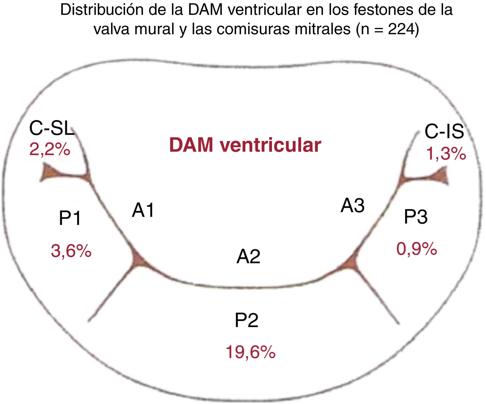 Descripción Y Prevalencia De La Disyunción Del Anillo Mitral Y El