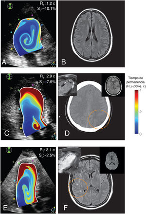 Ejemplos representativos de imágenes del tiempo de residencia y el objetivo principal. A y B: mapas de RT y RM cerebral potenciada en T2 y FLAIR (fluid-attenuated inversion recovery) de un paciente sin objetivo principal. C y D: mapas de RT y tomografía computarizada cerebral de un paciente con ictus isquémico y trombosis mural del VI (figuras insertadas: RMC y RM cerebral potenciada en T2 y FLAIR). E y F: mapas de RT e imágenes cerebrales potenciadas en T2 y FLAIR de un paciente con un ICS (figuras insertadas: RMC y RM cerebral ponderada por difusión, que muestra la naturaleza aguda de las lesiones). En todos los casos, los mapas de RT se superponen al modo B del ecocardiograma. En el extremo superior derecho de las figuras A, C y E se indican los valores individuales del strain apical, SL, y tiempo de residencia RT.