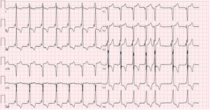 Graphical Abstract Miocardiopatía hipertrófica en el contexto de di...