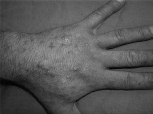 Eczema on the dorsal aspect of the hand.