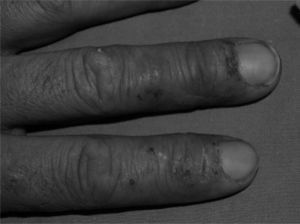 Chronic eczema on the fingers.