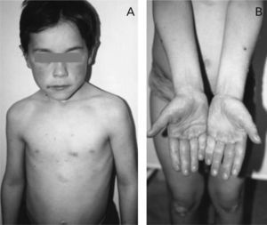 Persistence of malar (A) and palmar (B) erythema after treatment with antihistamines.