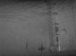Following the Skin Prick test, 10-3 dilution of the 1mg/ ml solution of sodium lauryl sulphate caused the formation of an oedema with 6mm in diameter and erythema with 30mm in diameter.
