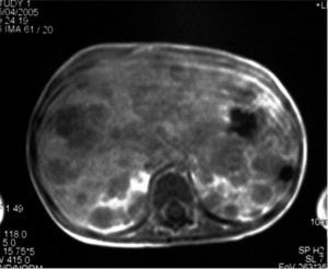 Nodular lesions in the liver and kidneys.