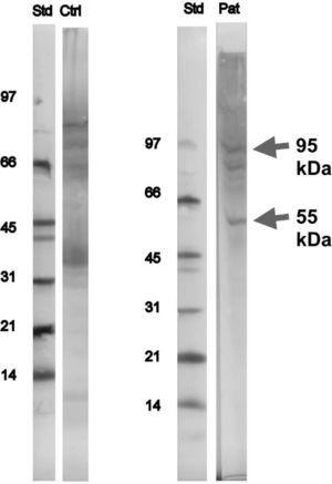 SDS-PAGE and immunoblotting with snail extract were performed with the patient sample (Pat) and an in-house sample (Ctrl) with identification of two bands, a distinct one at 55 and a faint at 95kDa.