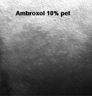 Patch test with ambroxol (10 % pet) positive at 96h (+++).