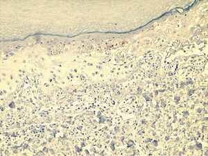 Note spare anti-CD8 immunoreactive lymphocytes in the epithelium. CD8, x100.