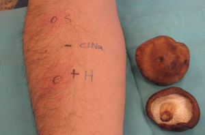 Positive prick result to Shitake Prick-to-prick. “H”=histamine (positive control). “S”=Shiitake.