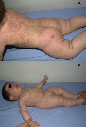 March 2003, 6 month old boy. Maculopapular, pruritic skin lesions; widespread on the trunk.