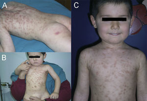 A, B October 2005, 3 year old boy. Maculopapular, non-pruritic skin lesions. Colour faded; no new lesions. C. March 2007, 4.5 year old boy. Maculopapular, non-pruritic skin lesions. Colour faded; no new lesions.
