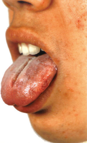 Detail of an erosive lesion on the tongue.