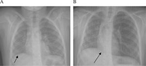 Chest X-rays in inspiration (A) and expiration (B), showing asymmetric lung volume with smaller size right hemithorax. No air entrapment is seen.