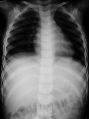 Normal chest X-ray upon admission.
