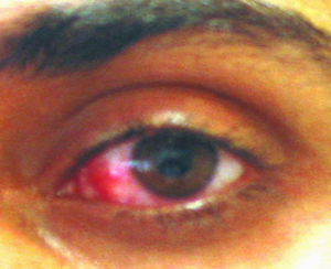 Conjunctivitis with oedema and hyperaemia of conjunctiva.