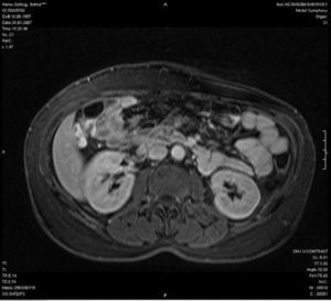 MR image of bilateral adrenal gland.