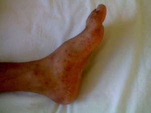 A dispersed red-purple colored maculopapular rash that pales under pressure was shown around ankle and medial side of the foot.