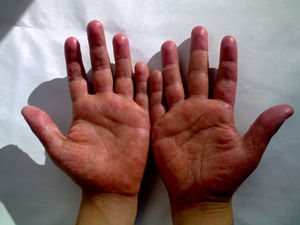 Red-purple colored erythematous maculopapular lesions that show desquamation in patches were seen on bilateral palmar regions.