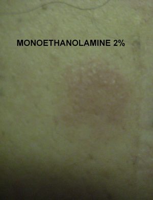 Reaction to patch test with MEA 2% pet. at 48hours.