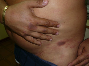 Erythematous and hyperpigmented plaques on the right hand and left groin.