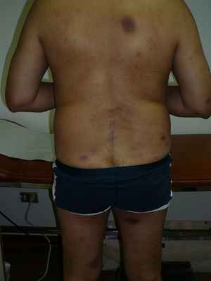 Fixed drug eruption lesions on the back and posterior surfaces of the thighs.