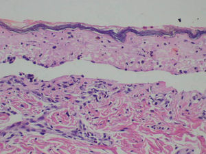 Keratinocytes necrosis with subepidermal bullous lesions showed in skin biopsy specimen. (Hematoxylin-eosin x 100).