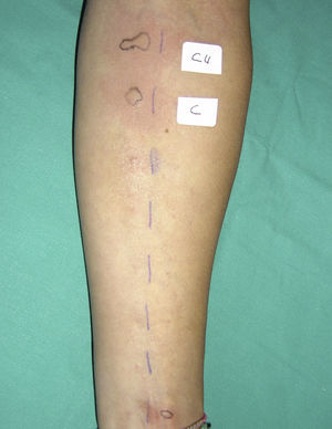 Positive skin prick test with curry (Cu) and coriander (C). Negative skin prick test with curcuma, mustard, cinnamon, onion, garlic, fennel, ginger, black pepper, laurel, nutmeg, cardamom and clove.