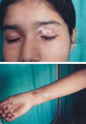 Vitiligo on the face with morphoea on the volar aspect of right wrist.