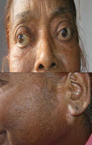 Patient with Grave