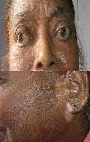 Patient with Grave's disease (showing exophthalmos) with patch of vitiligo on the face.