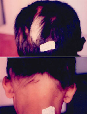Patch of vitiligo with poliosis with alopecia areata (ophiatic pattern also seen).