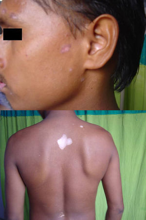 Discoid lupus erythematosus with vitiligo.
