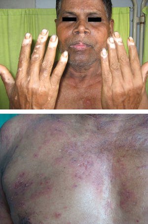 Patient of acromucosal vitiligo with pemphigus erythematosus (close up view of vesicles, erosions on erythematous plaques on chest).
