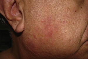 Erythematous scaly plaques in cheek.