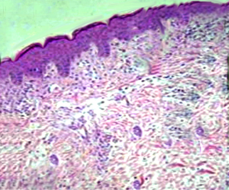Tmep Rash Skin Telangiectasia macularis eruptive perstans (TMEP) in childhood: A case ...