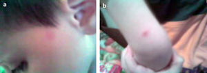 Skin manifestations of TMEP in our patient's: face (a) and limbs (b and c).