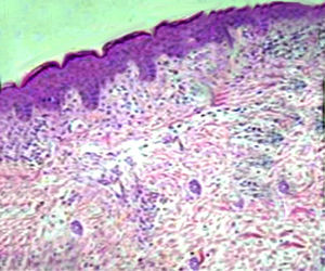 Electronic microscopy image of the skin biosy: diffuse ectasia of capillaries and small superficial dermal inflammation, modest amount of perivascular lymphocytic plasma cells and an increased number of mast cells.