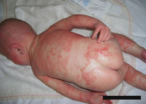 Erythroderma, hypotrichosis and areas with ichthyosis linearis circumflexa.