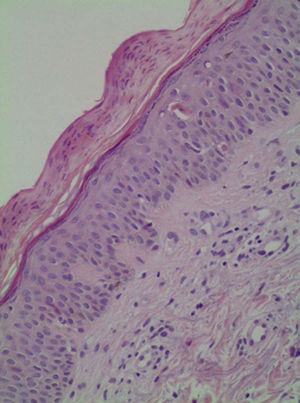 Biopsy of affected skin showed parakeratosis of stratum corneum with vacuolar degeneration and isolated eosinophils in superficial dermis.