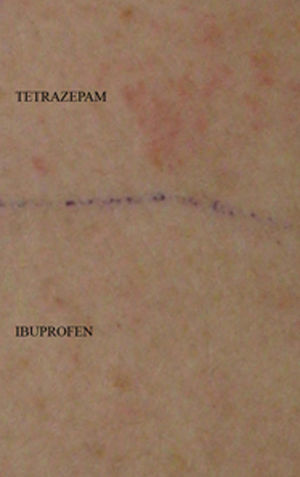 Positive patch test to tetrazepam.