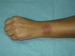 Erythema on the wrist lesion after single-blind oral challenge with norfloxacin.