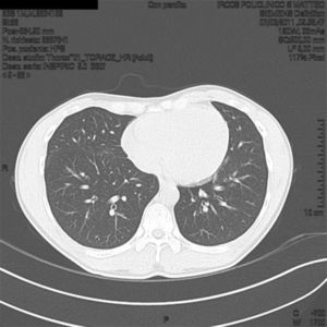 High resolution computed tomography (HRCT) lung at T0 shows in the expiratory phase a marked and uneven alteration in density of both lungs for the coexistence of higher density and hyperlucency areas (part of the mosaic attenuation). These areas represent pulmonary expiratory air trapping secondary to obstruction of the small airways.