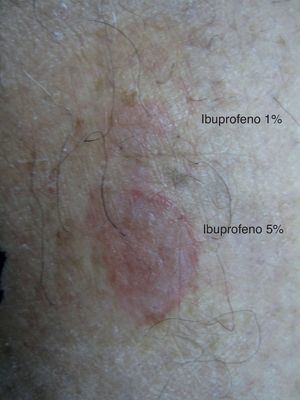 Patch test positive with ibuprofen 1% and 5% on the residual lesion.