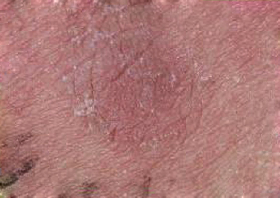 Atopy Diagnostic accuracy of atopy patch tests for food allergy in children ...