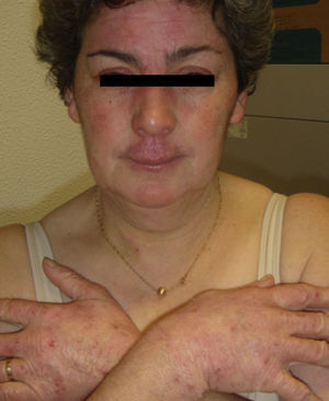Erythemato-squamous dermatitis, involving the face, eyelids, earlobes, retroauricular fold, neckline, extensor surface of the hands and forearms.