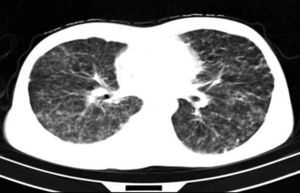 Diffuse bilateral tiny nodular infiltration with scattered foci of bronchiectasis in left lung.