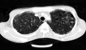 Bronchiectasis with some pribronchial wall thickening in left upper lobe and tiny nodular in right upper lobe and larger sub pleural nodules in left upper lobe.