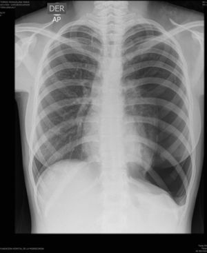 Chest radiograph showing right upper lobe cystic parenchymal lesions, pneumothorax with left lung passive atelectasis, with normal cardiovascular silhouette.
