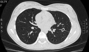 High-resolution computed tomography scan of the chest showing multiple well-defined, thin-walled cystic parenchymal lesions distributed diffusely throughout the lungs, and closed left thoracostomy tube with a small residual left pneumothorax, with normal cardiovascular structures.